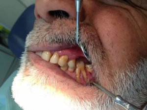 “老掉牙”会致使老年痴呆？
