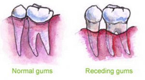 为什么牙龈会萎缩？