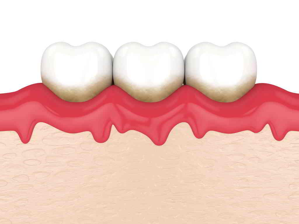 牙龈出血是什么？
