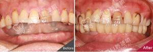 深圳馮小姐半口種植牙案例