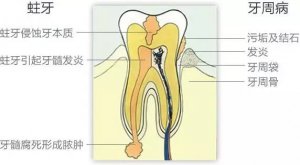 牙齿疾病的危险信号，你中了几招？